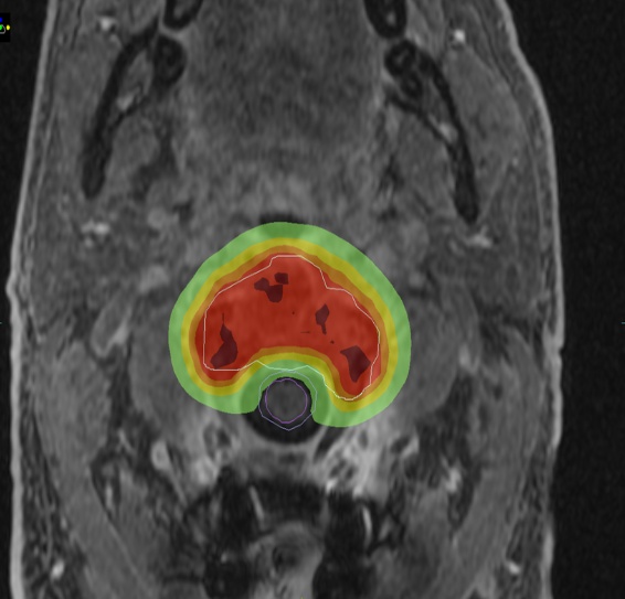 cordoma cervical, curvas de isodoses de radioterapia